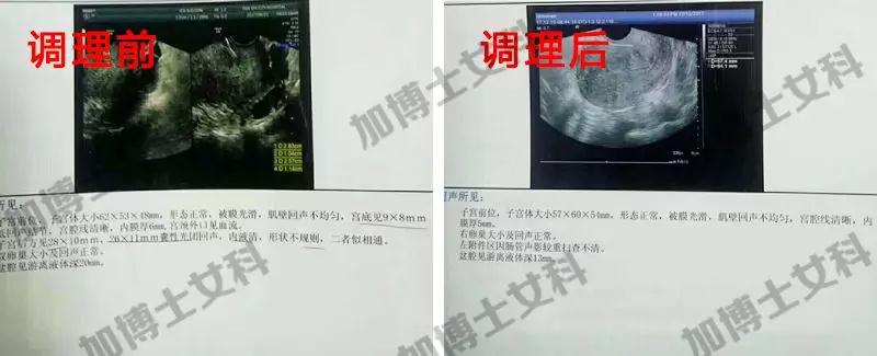 不(bù)做(zuò)b超，哪些(xiē)症狀代表子(zǐ)宮肌瘤正在好(hǎo)轉呢(ne)？